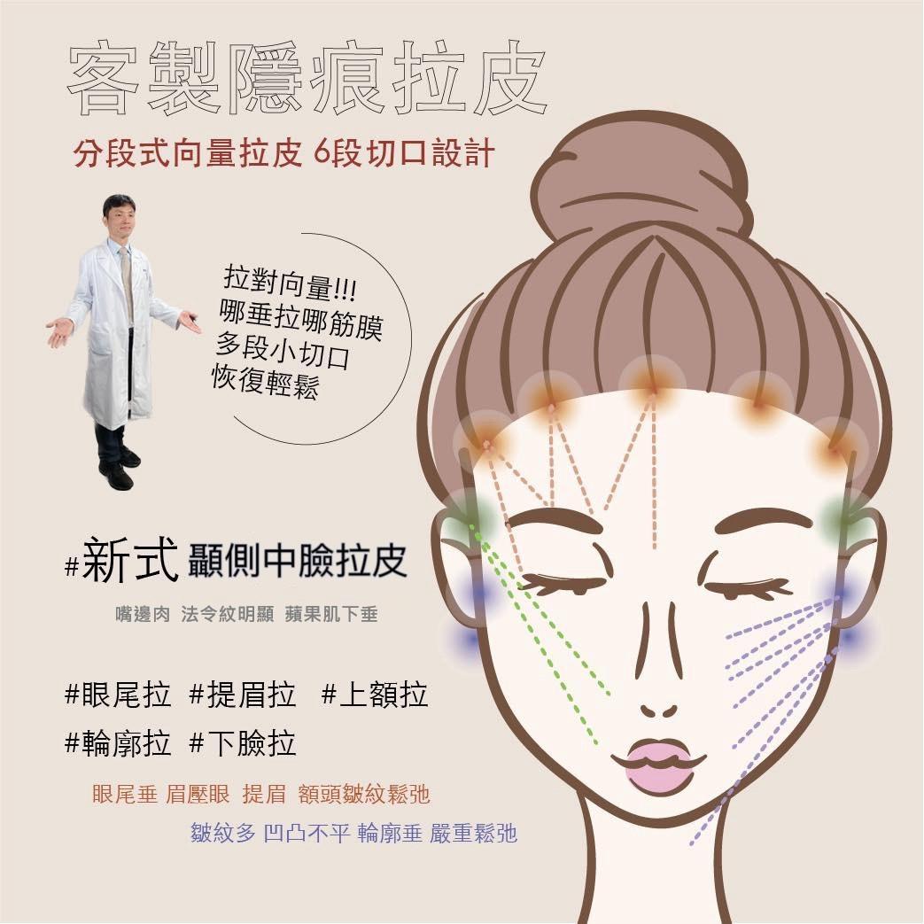 新式顳側拉皮到底是什麼？