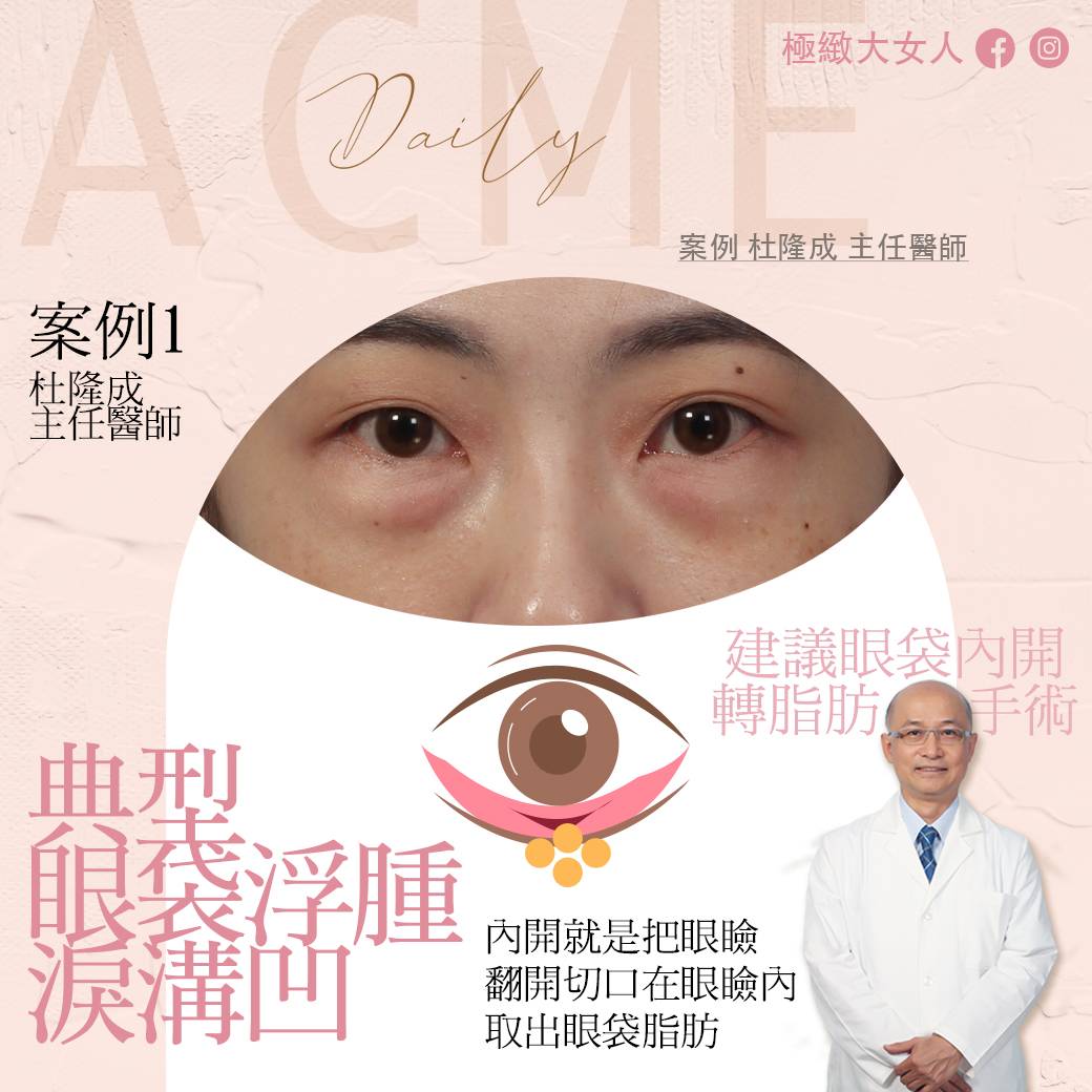 眼下疲勞眼袋作祟？