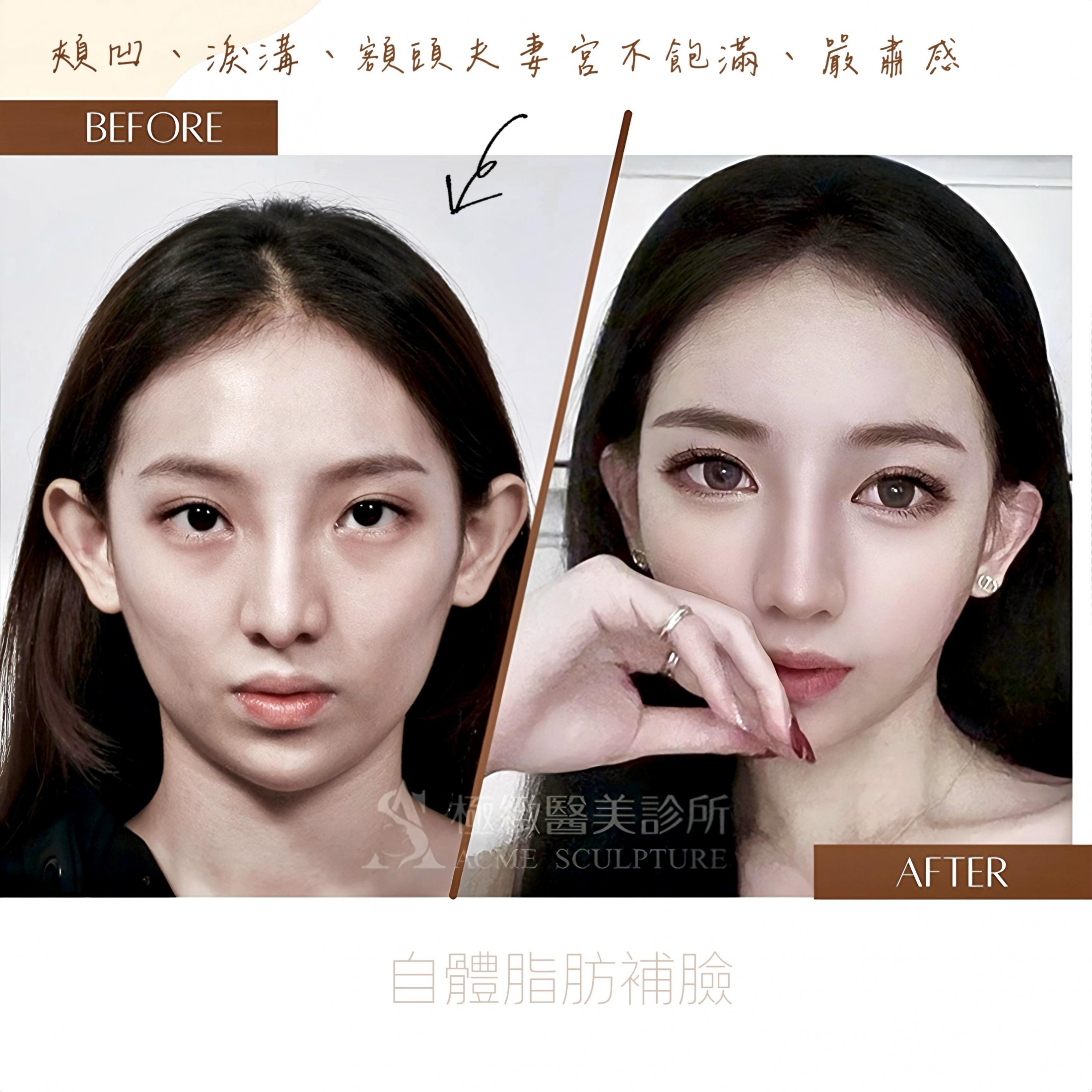 全臉脂肪到底怎麼消失的？