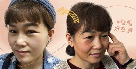 New顳側拉皮｜術後1週就開懷大笑～親身分享(多圖紀錄分享)