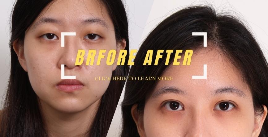 提眼肌無力｜勇敢跨出變身小美女