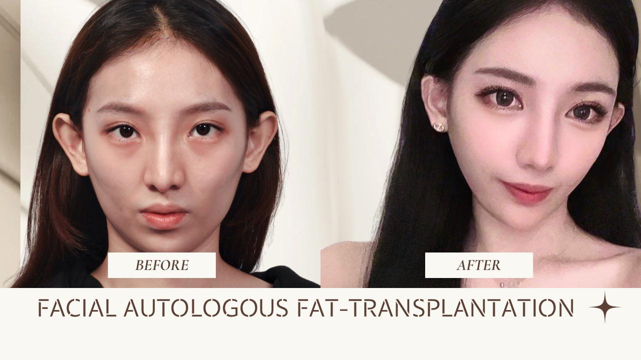 自體脂肪臉雕｜流失的膠原蛋白來拯救～提升質感臉