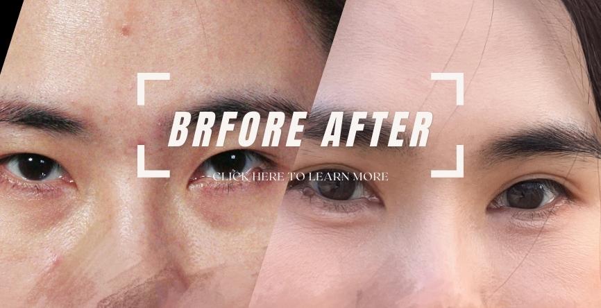 複合式眼整形｜瞇瞇眼真的不要放棄！（素人親身分享）