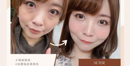 隱痕眼袋手術｜醫美票選CP很高的手術!!