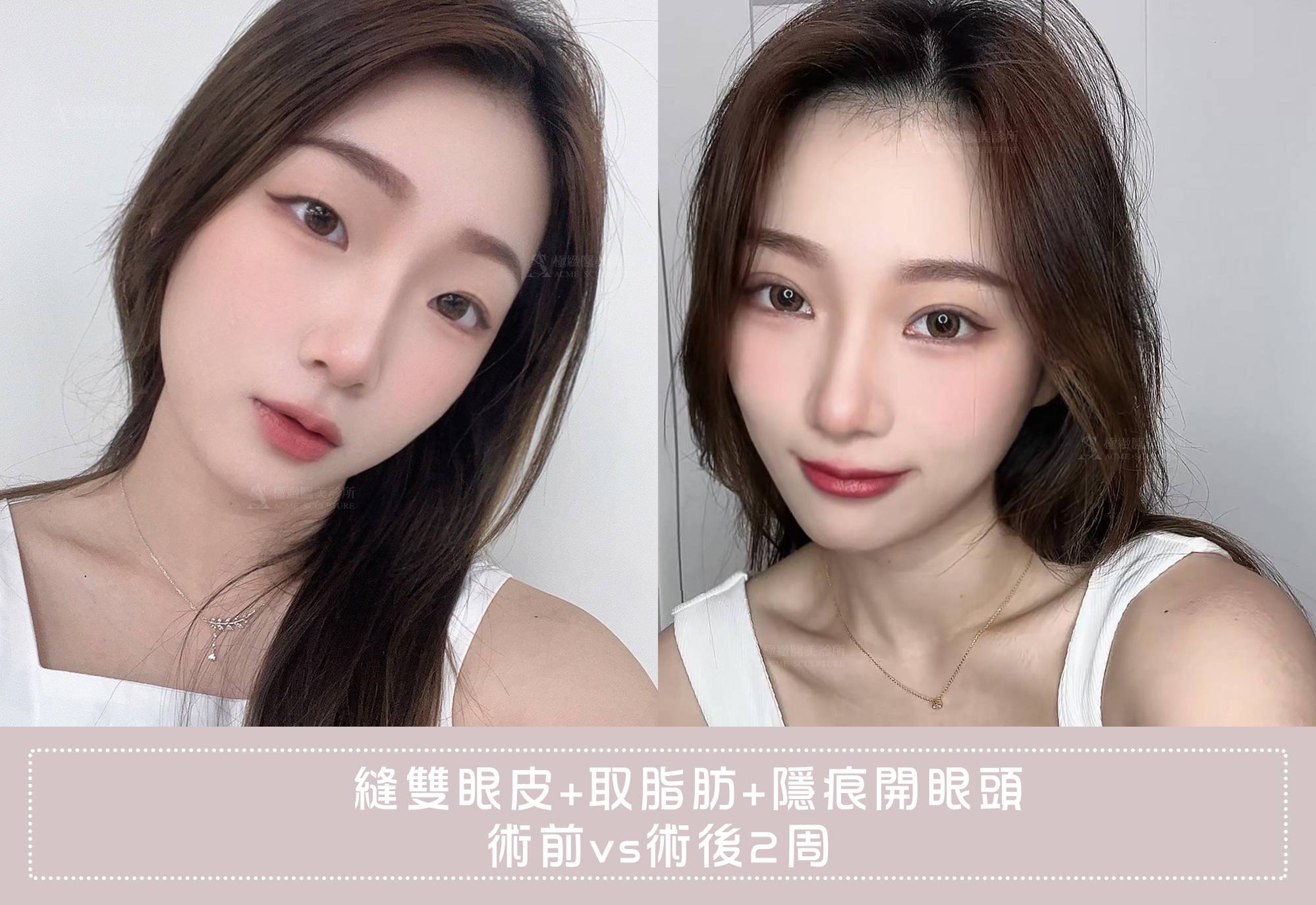 縫雙眼皮+取脂肪 隱痕開眼頭｜變身歐膩溫柔小姊姊～