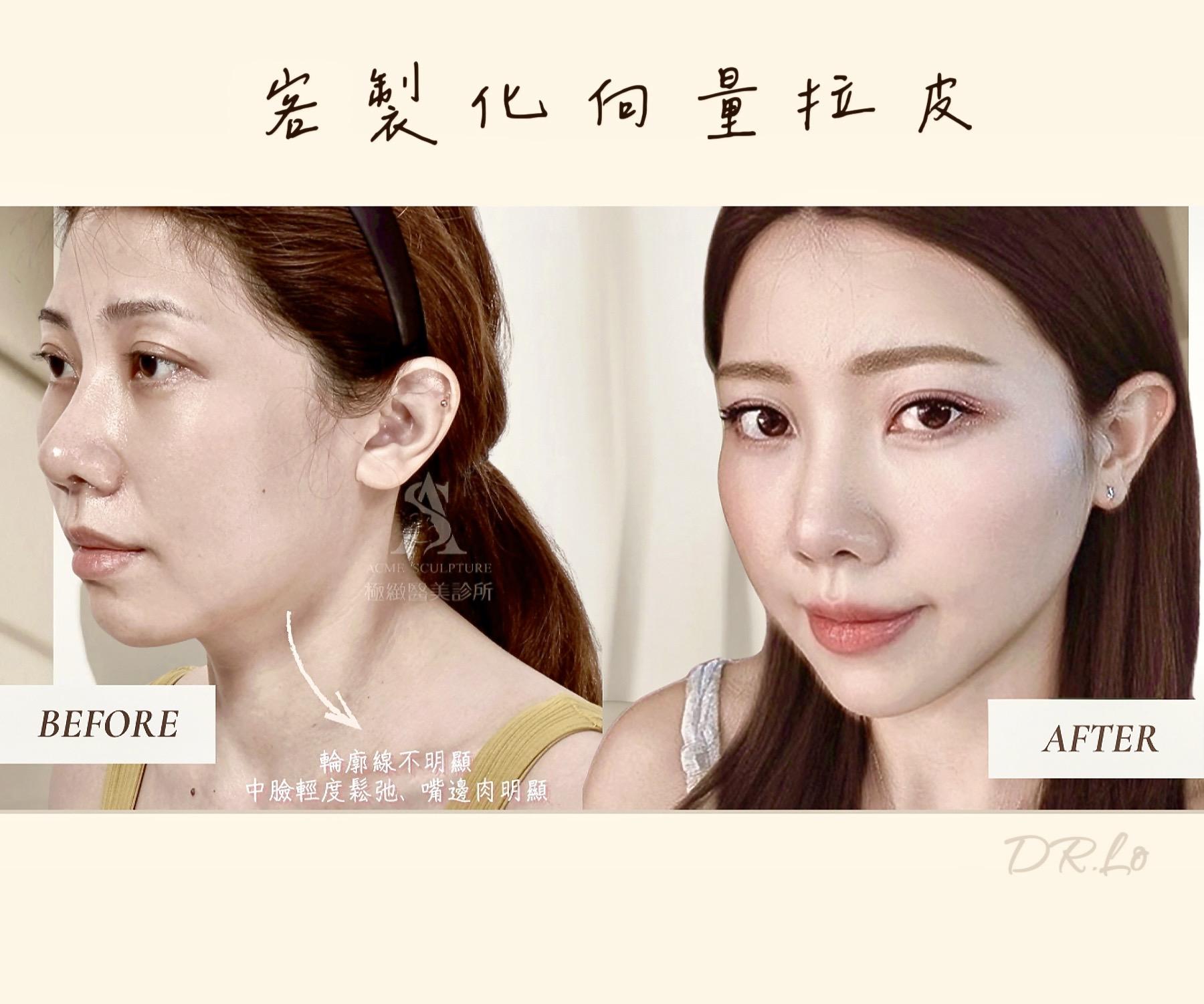 減肥後遺症｜臉垂、皮鬆、頰凹很顯老? 顳側中臉拉皮+臉部補脂 找回緊緻澎潤臉