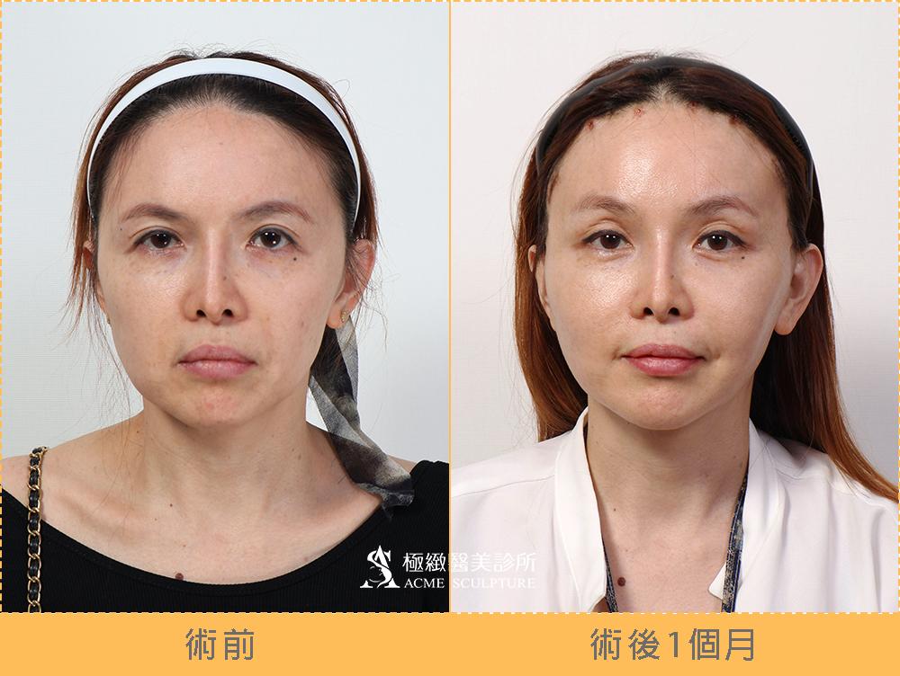 客製化向量拉皮｜終結眼尾下垂、嘴邊肉！